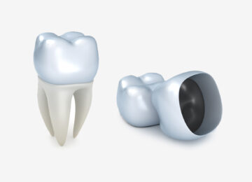 All About Dental Crowns