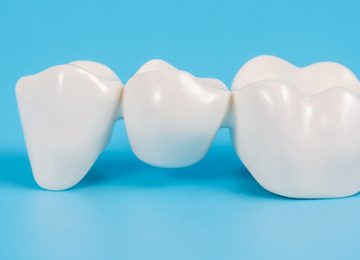 Types of Dental Bridge: A Suitable Option for Me