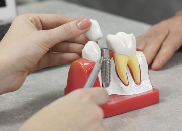 Step-by-Step: The Dental Implant Process