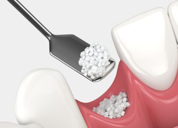 Is Oral Bone Grafting Right for You? Key Factors to Consider