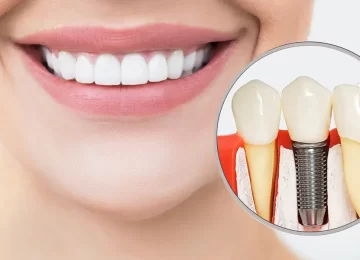 Long-Lasting Dental Implants in Bronxville