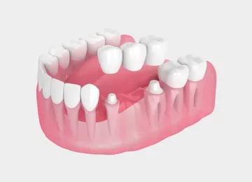 What Are the Signs Your Dental Bridge Needs Replacement?